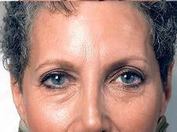 Den meisten Botox-Patienten geht es um ein erholtes Aussehen.